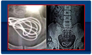 సీరియల్స్‌లో నటించే.. అన్నాచెల్లెలు ఆత్మహత్య