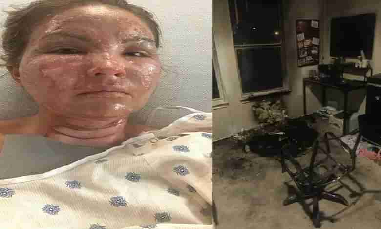 అందమైన మొహాన్ని పాడుచేసిన శానిటైజర్