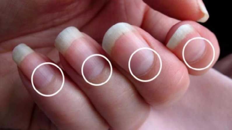 Nails Shows Your Health : మన చేతి గోర్లు తీరును బట్టి ఆరోగ్య సమస్యలను తెలుసుకోవచ్చు అంటున్న నిపుణులు