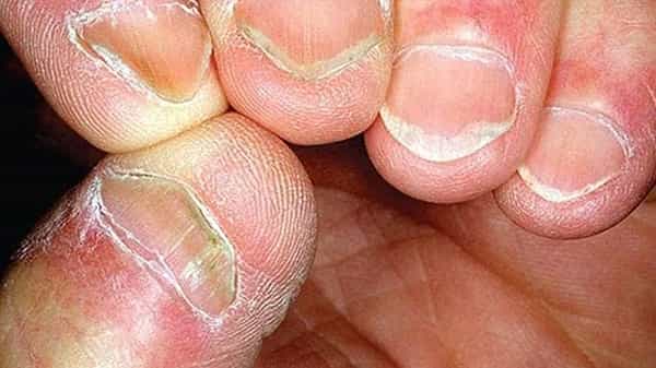 Nail biting habit: మీకు గోళ్లు కొరికే అలవాటు ఉందా.. ఈ అనర్థాలు తెలిస్తే.. మరోసారి వేళ్లు నోటి వరకు వెళ్లవు..!