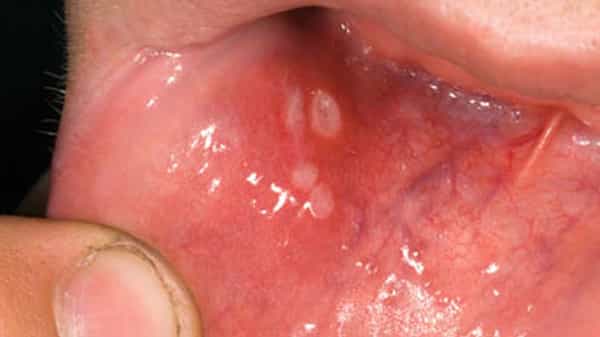 Mouth Ulcers: నోటి పూతతో బాధపడుతున్నారా..? అయితే సులువుగా ఇలా తగ్గించుకోవచ్చు తెలుసా..