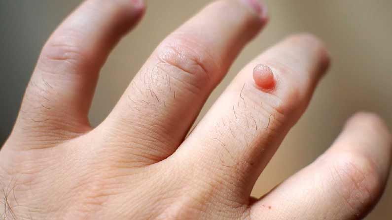 Natural Wart Removal Tips: మిమ్మల్ని పులిపిర్లు ఇబ్బంది పెడుతున్నాయా..! సహజ పద్ధతుల్లో ఇలా తగ్గించుకోవచ్చు