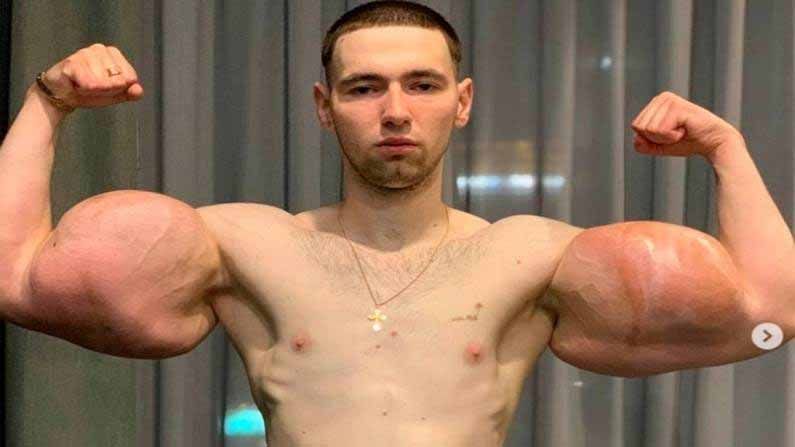 Russian Bodybuilder: ఇవి ఒరిజినల్ బైసెప్స్ కావు.. అతిగా ఆలోచించాడు.. ఇప్పుడు మూల్యం చెల్లించుకుంటున్నాడు