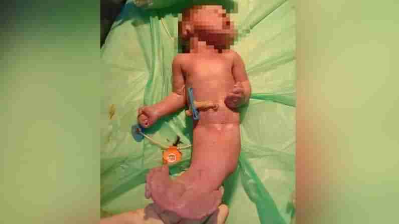 Mermaid Baby :  హైదరాబాద్‌లో మత్యకన్య రూపంలో జన్మించిన శిశువు.. పుట్టిన రెండు గంటల్లోనే మృతి
