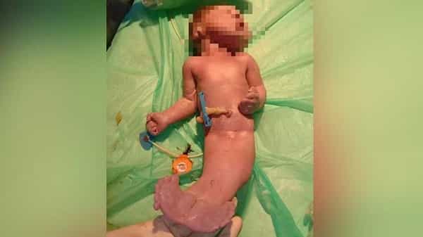 Mermaid Baby : హైదరాబాద్లో మత్యకన్య రూపంలో జన్మించిన శిశువు.. పుట్టిన రెండు గంటల్లోనే మృతి