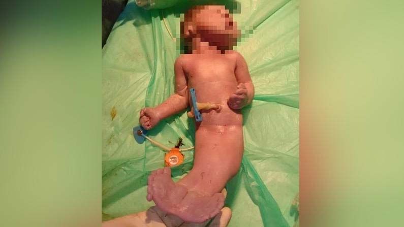 Mermaid Baby :  హైదరాబాద్‌లో మత్యకన్య రూపంలో జన్మించిన శిశువు.. పుట్టిన రెండు గంటల్లోనే మృతి