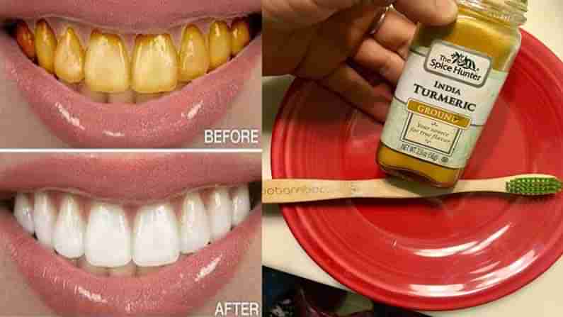 Turmeric For Teeth : మెరిసే దంతాల కోసం చింతా.. పసుపు మీ చెంతన ఉందిగా.. ఎలా వాడాలంటే..!