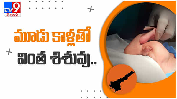 Guntur GGH hospital: మూడు కాళ్లతో జన్మించిన వింత శిశువు...!! చివరకి ఏమైందంటే... ( వీడియో )