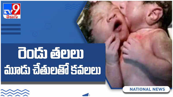 Conjoined Twins: రెండు తలలు... మూడు చేతులతో కవలలు... ఎక్కడో తెలుసా...?? ( వీడియో )
