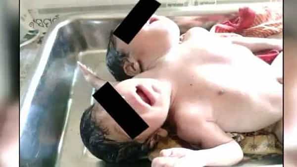 Conjoined Twins: రెండు తలలు.. మూడు చేతులతో కవలల జననం.. ఈ విచిత్ర ఘటన ఎక్కడో తెలుసా..