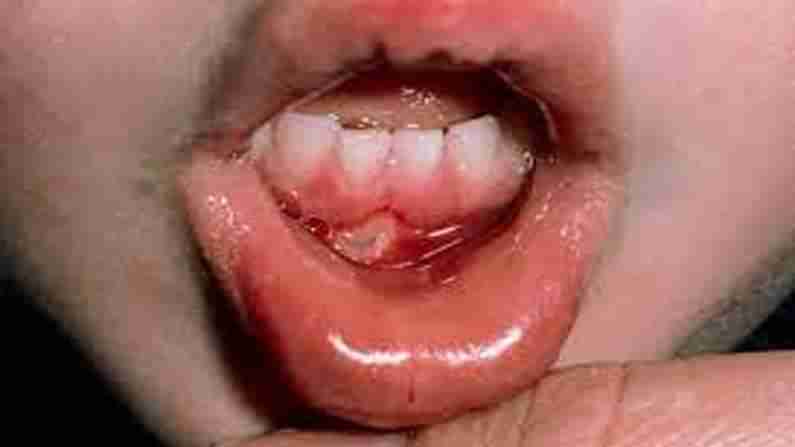 Mouth Ulcers: నోటిపూతతో బాధపడుతున్నారా..? నివారణకు అద్భుతమైన చిట్కాలు..