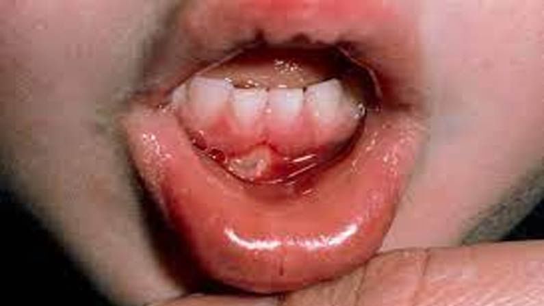 Mouth Ulcers: నోటిపూతతో బాధపడుతున్నారా..? నివారణకు అద్భుతమైన చిట్కాలు..