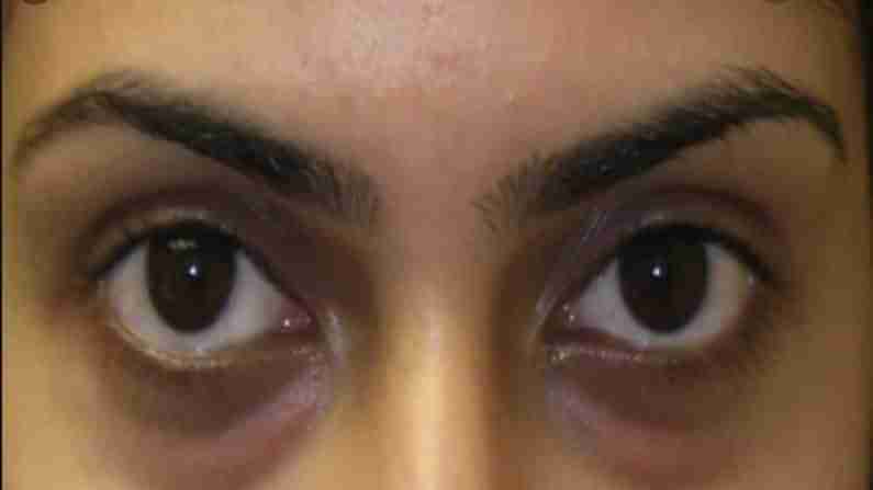 Dark Circles : కళ్లకింద నల్లటి ముడతలతో ఇబ్బందిగా ఉందా..? అయితే ఈ పద్దతులు పాటించి సింపుల్‌గా తొలగించుకోండి..