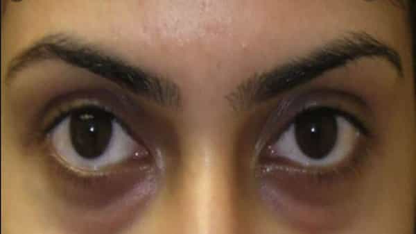 Dark Circles : కళ్లకింద నల్లటి ముడతలతో ఇబ్బందిగా ఉందా..? అయితే ఈ పద్దతులు పాటించి సింపుల్గా తొలగించుకోండి..