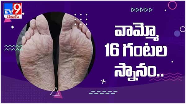 Viral Video:16 గంటల పాటు స్నానం చేసిన మహిళా...!! దాని ఫలితంగా ఒక వింత వ్యాధి.. ( వీడియో )