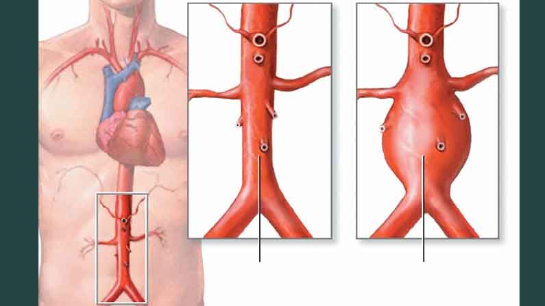 Aortic Aneurysm: సైలెంట్ కిల్లర్ బృహద్ధమని సంబంధ అనూరిజం అంటే ఏమిటి? దీనిని గుర్తించడం ఎలా?