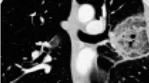 Black Fungus : ఊపిరితిత్తుల్లో బ్లాక్ ఫంగస్..! దేశంలోనే మొదటి కేసు..? ఆశ్చర్యపోయిన వైద్యులు