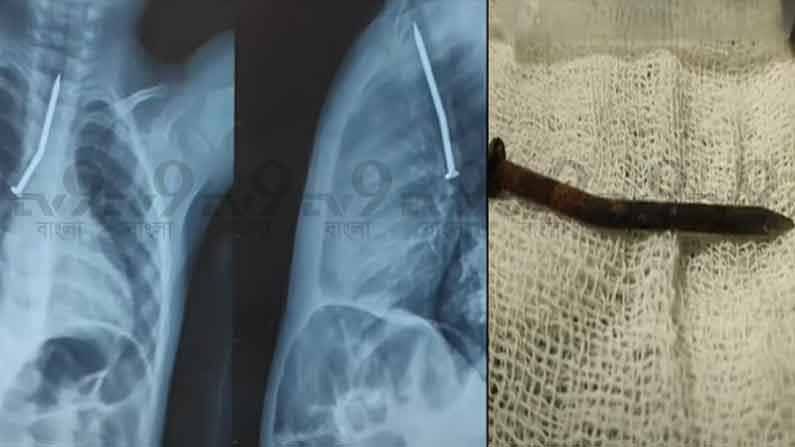 Boy Swallows Iron Nail : 7 అంగుళాల ఇనుప మేకును మింగిన 2 ఏళ్ల పిల్లవాడు..! శ్వాసనాళంలో చిక్కుకొని 21 గంటలు అవస్థలు..