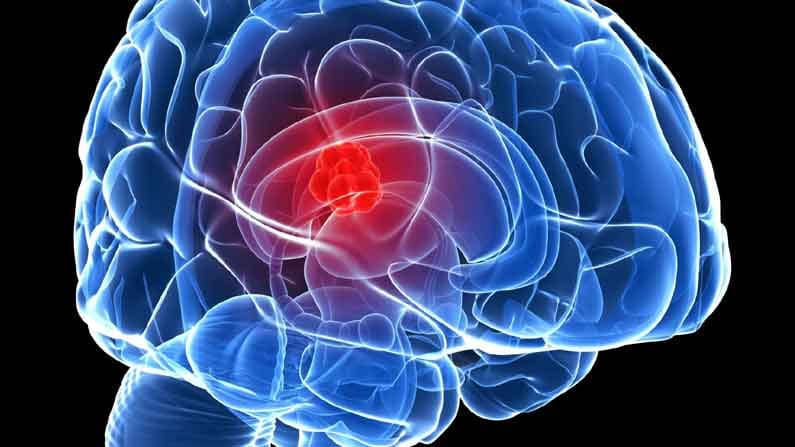 Brain tumor: మెదడులో కణితులు.. బ్రెయిన్ కేన్సర్ ఒక్కటేనా? దీని లక్షణాలపై ఉన్న అపోహలను తొలగించుకోండి