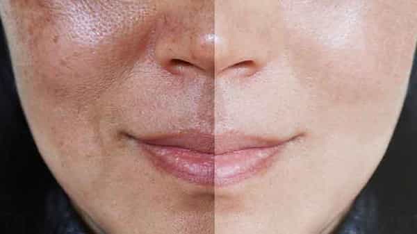 Hyperpigmentation: నిద్ర లేకపోవడమే కాదు.. ఎక్కువైనా కూడా కళ్ళ కింద నలుపు వస్తుంది..దీనిని ఎలా నివారించాలి?