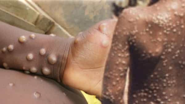Monkeypox: మంకీ పాక్స్ వైరస్ ఎలా వ్యాప్తి చెందుతుంది..? లక్షణాలు, చికిత్స.. ఇతర వివరాలు