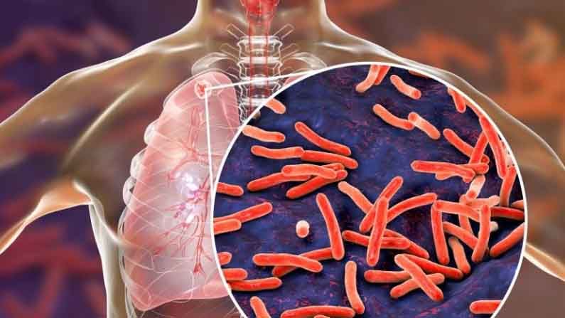 Tuberculosis: టీబీ చికిత్సలో సాధారణ యాంటీబయాటిక్స్ సమర్థవంతంగా పని చేస్తాయి..తాజా పరిశోధనల్లో వెల్లడి