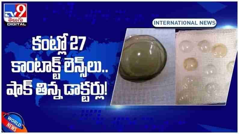 Viral Video:  67 ఏళ్ల మహిళ కంట్లో 27 కాంటాక్ట్‌ లెన్స్‌లు..!! షాక్‌ తిన్న డాక్టర్లు..!! ( వీడియో )