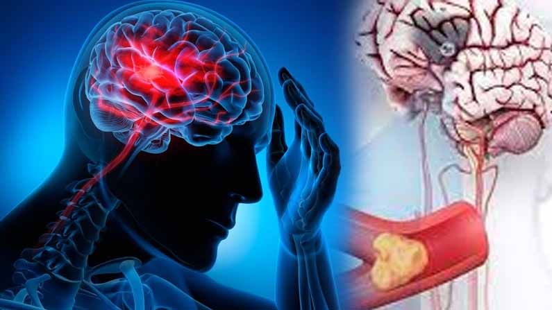 Brain Stroke: మన దేశంలో మరణాలకు మూడో అనారోగ్య కారణం బ్రెయిన్ స్ట్రోక్..దీని కారణంగా ఎంతమంది చనిపొతారో తెలుసా?