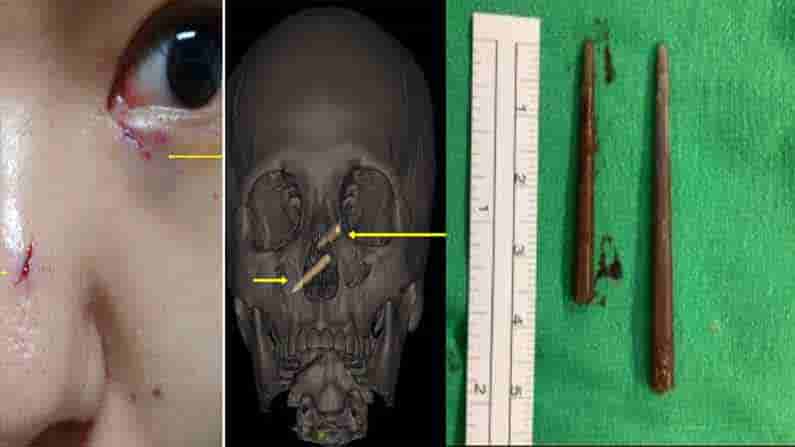 Chopstick Pieces: అక్కాచెల్లెళ్ల కొట్లాట.. ముక్కుల్లో కర్ర ముక్కలు ఇరుక్కుపోయిన వైనం..వారం తర్వాత గుర్తింపు