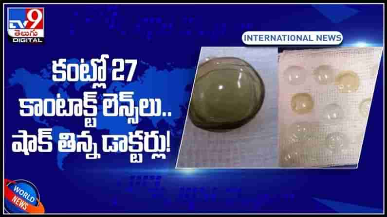 Contact Lenses Video:కంట్లో 27 కాంటాక్ట్‌ లెన్స్‌లు.. షాక్‌ తిన్న డాక్టర్లు! కాంటాక్ట్‌ లెన్స్‌ విషయంలో నిర్లక్ష్యం..(వీడియో).