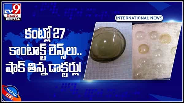 Contact Lenses Video:కంట్లో 27 కాంటాక్ట్ లెన్స్లు.. షాక్ తిన్న డాక్టర్లు! కాంటాక్ట్ లెన్స్ విషయంలో నిర్లక్ష్యం..(వీడియో).