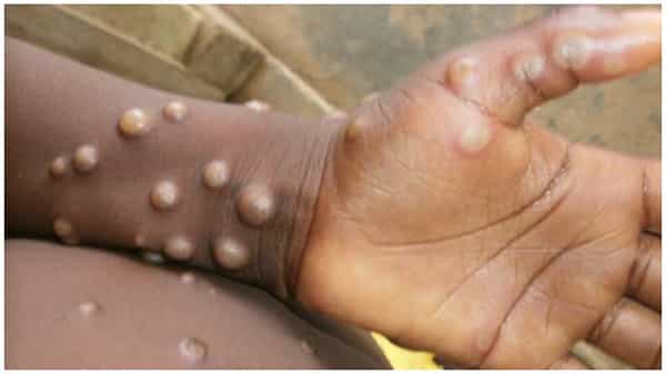 Monkey Pox: టెక్సాస్ వ్యక్తికి మంకీ పాక్స్.. తొలి కేసు నమోదు.. ఆందోళనలో అమెరికా