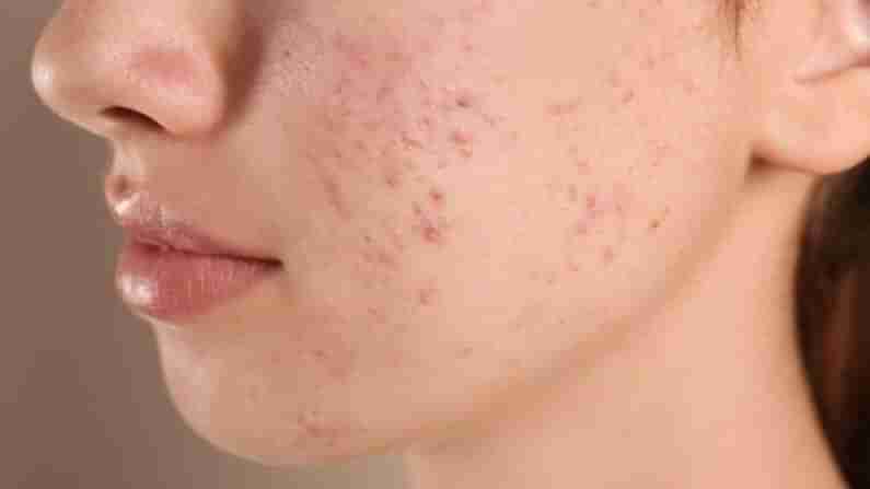 Beauty Tips : ముఖంపై నల్లటి మొటిమల మచ్చలతో ఇబ్బంది పడుతున్నారా..! అయితే తక్కువ ఖర్చుతో ఇంట్లోనే తొలగించుకోండి..