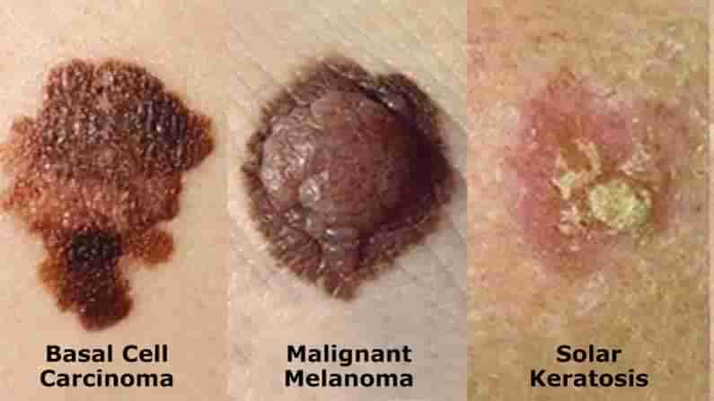 Skin Cancer: చర్మ సంబంధ కేన్సర్‌ను యాంటీ బయాటిక్స్ సమర్ధవంతంగా ఎదుర్కొంటాయి.. తాజా పరిశోధనల్లో వెల్లడి 