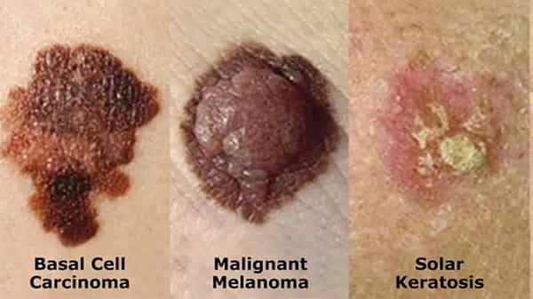 Skin Cancer: చర్మ సంబంధ కేన్సర్ను యాంటీ బయాటిక్స్ సమర్ధవంతంగా ఎదుర్కొంటాయి.. తాజా పరిశోధనల్లో వెల్లడి