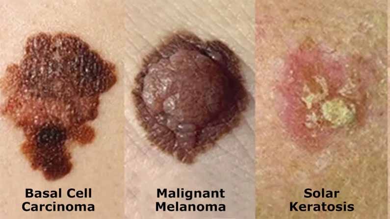 Skin Cancer: చర్మ సంబంధ కేన్సర్‌ను యాంటీ బయాటిక్స్ సమర్ధవంతంగా ఎదుర్కొంటాయి.. తాజా పరిశోధనల్లో వెల్లడి 
