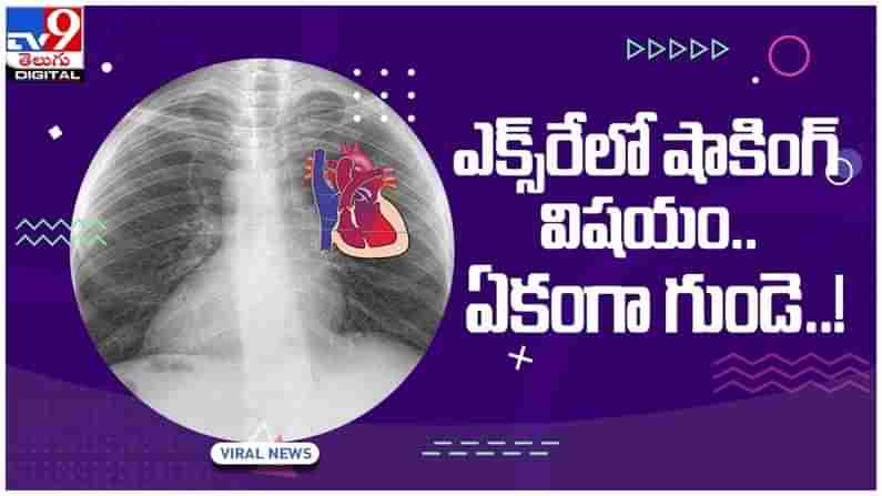 Viral Video: రోగి ఎక్స్‌రే చూసి డాక్టర్ షాక్..!! ఏకంగా గుండె..!! అసలు విషయం ఏంటంటే..?? వీడియో