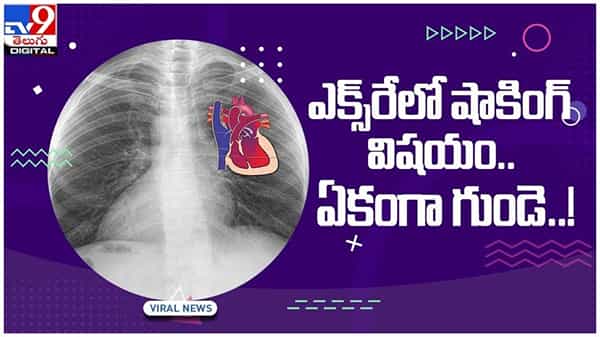 Viral Video: రోగి ఎక్స్రే చూసి డాక్టర్ షాక్..!! ఏకంగా గుండె..!! అసలు విషయం ఏంటంటే..?? వీడియో