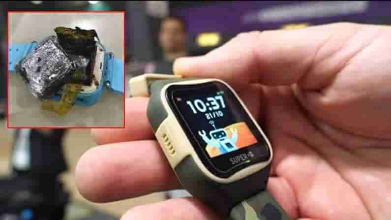 Smartwatch Explodes: నాలుగేళ్ల చిన్నారి చేతి మణికట్టుపై పేలిన స్మార్ట్‌ వాచ్‌.. తీవ్ర గాయాలు