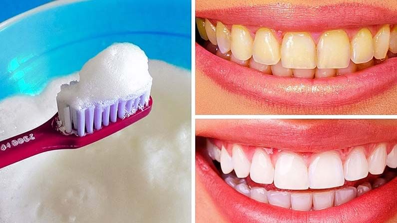 Yellow Teeth Home Remedies: పళ్ళు పసుపు రంగులోకి మారాయా..? ఈ టిప్స్ పాటిస్తే మిలమిల మెరవడం ఖాయం..