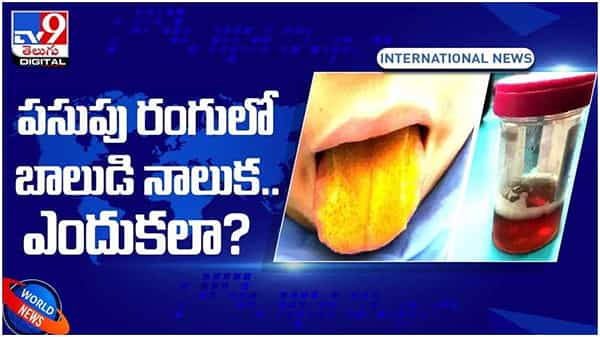 పసుపు రంగులోకి మారిన బాలుడి నాలుక..!! అరుదైన వ్యాధిగా గుర్తించిన డాక్టర్లు..!! వీడియో