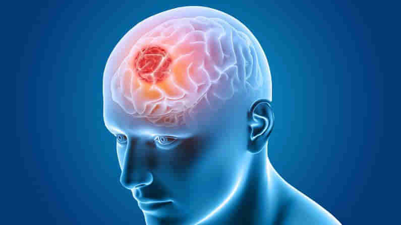 Brain Tumor: తలనొప్పి ఎక్కువ రావడం బ్రెయిన్ ట్యూమర్‌కు సంకేతమా? ఇది క్యాన్సర్‌గా మారుతుందా? తెలుసుకోండి!