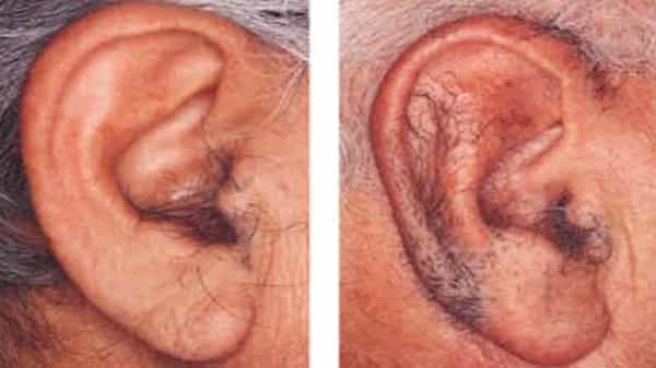 Hairy Ears: పురుషుల చెవిపై వచ్చే వెంట్రుకలు వల్ల ఏదైనా ప్రమాదాలు ఏర్పడతాయా..