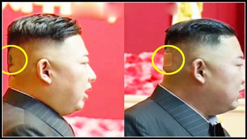 Kim Jong-un: నార్త్ కొరియా అధినేత కిమ్ జాంగ్ ఉన్ గాయపడ్డాడా..? మిస్టరీ స్పాట్, బ్యాండేజీతో కనబడిన నేత