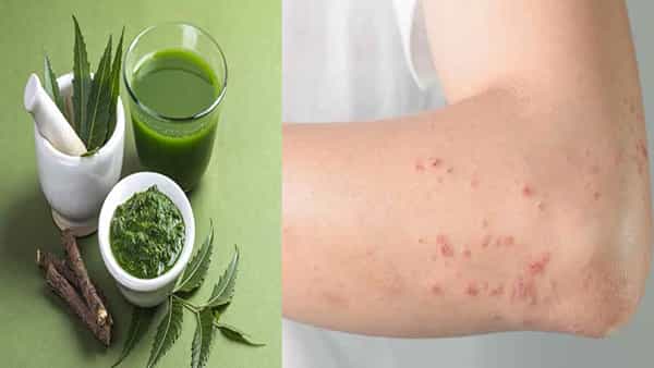 Skin Problems-Ayurveda Tips: సాధారణ చర్మవ్యాధులతో ఇబ్బంది పడుతున్నారా సైడ్ఎఫెక్ట్స్లేని ఈ సింపుల్ చిట్కాలు మీకోసం