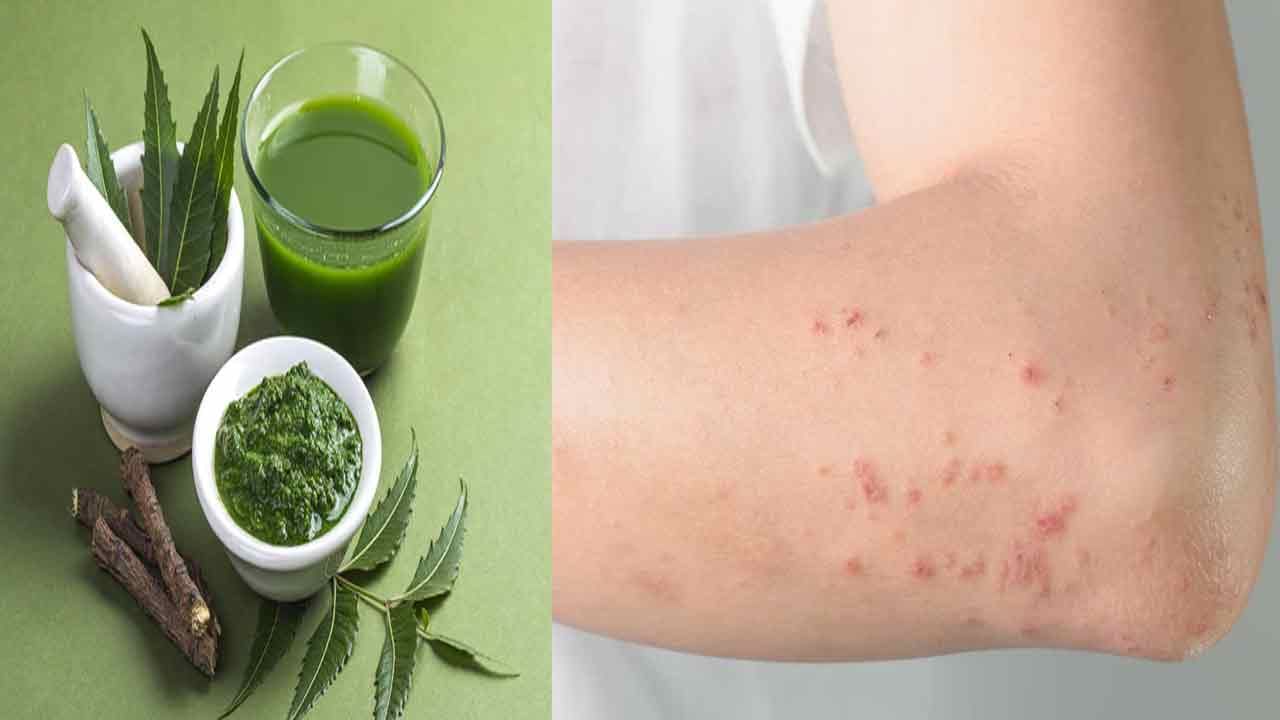 Skin Problems-Ayurveda Tips: సాధారణ చర్మవ్యాధులతో ఇబ్బంది పడుతున్నారా సైడ్‌ఎఫెక్ట్స్‌లేని ఈ సింపుల్ చిట్కాలు మీకోసం