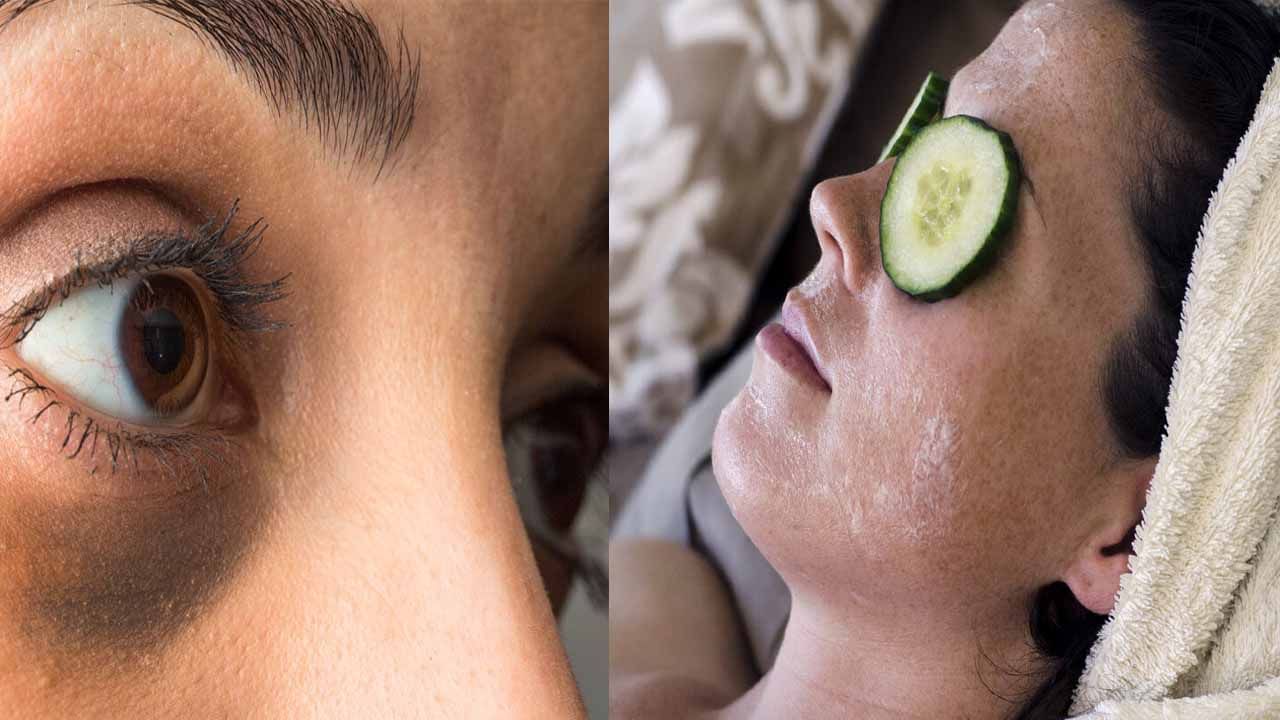 Eye Dark Circles: కళ్ల కింద నల్లటి వలయాలు పోగొట్టడం ఎలా..? అద్భుతమైన చిట్కాలు..!