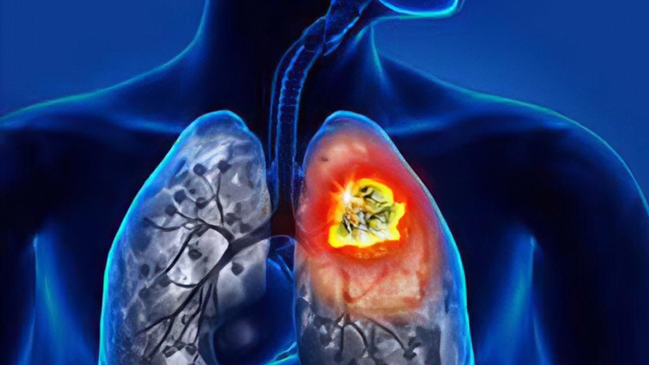 Lung Cancer: పొగతాగకపోయిన ఊపిరితిత్తుల కేన్సర్ వచ్చే అవకాశాలు.. అప్రమత్తంగా ఉండాలన్తున్న శాస్త్రవేత్తలు