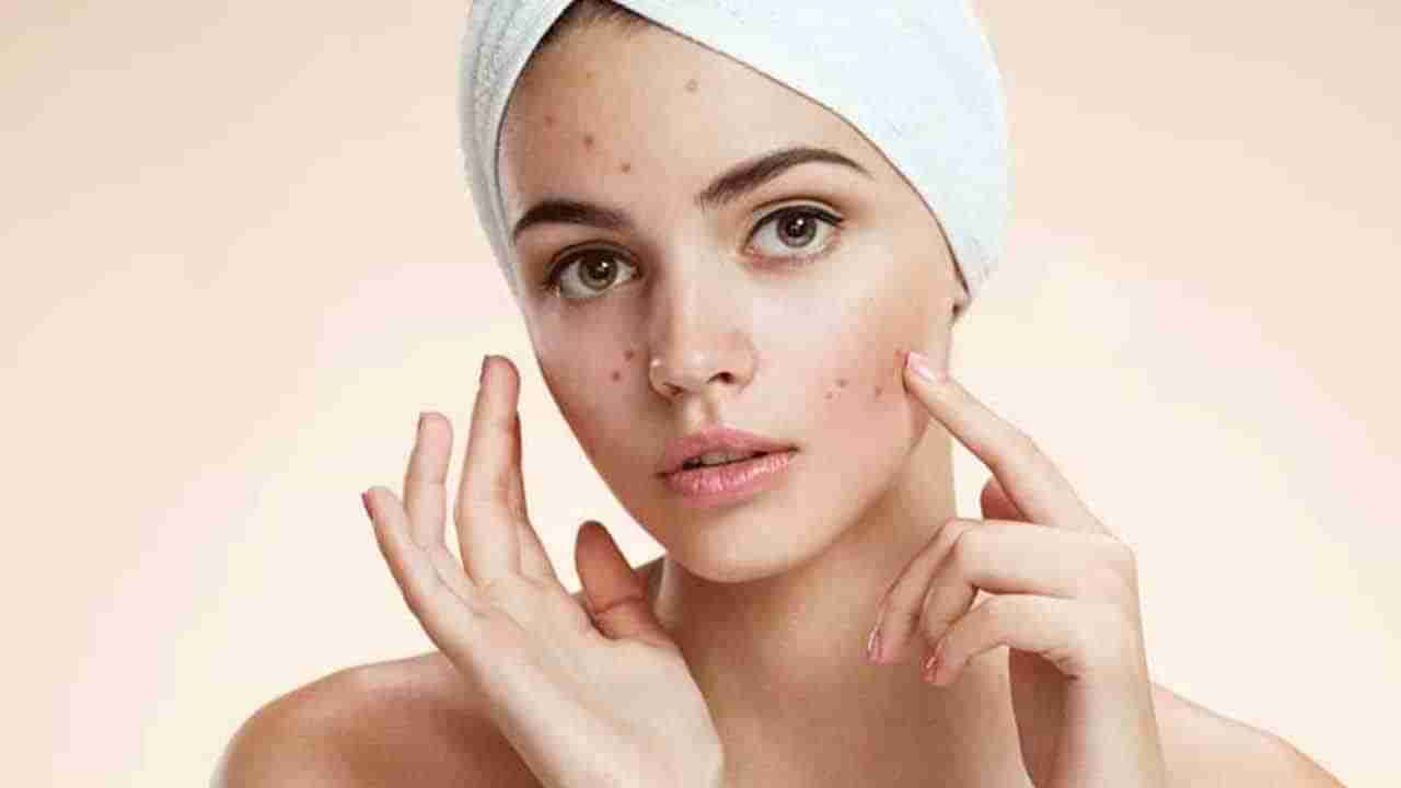 Beauty Tips For Skin: మొటిమలు, మచ్చలు లేని ముఖారవిందం కావాలా? అయితే ఈ 5 టిప్స్ ఫాలో అవ్వండి..