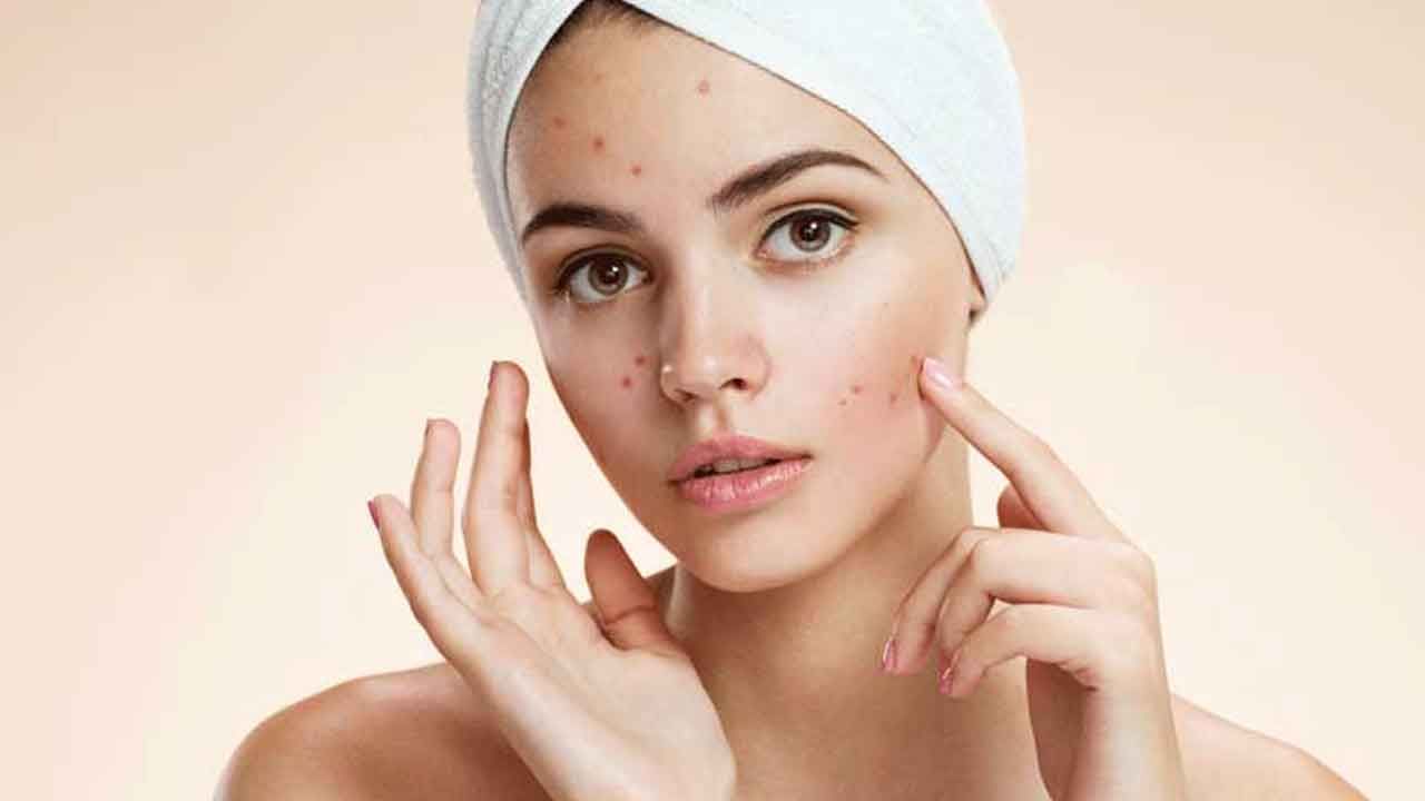 Beauty Tips For Skin: మొటిమలు, మచ్చలు లేని ముఖారవిందం కావాలా? అయితే ఈ 5 టిప్స్ ఫాలో అవ్వండి..